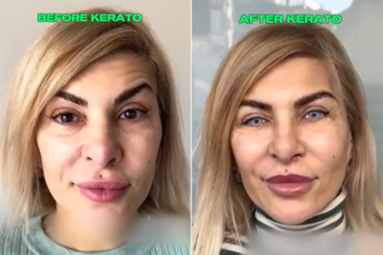 The new trend taking over and dividing users on TikTok is the eye tattoo – How Keratochromatosis Is Done