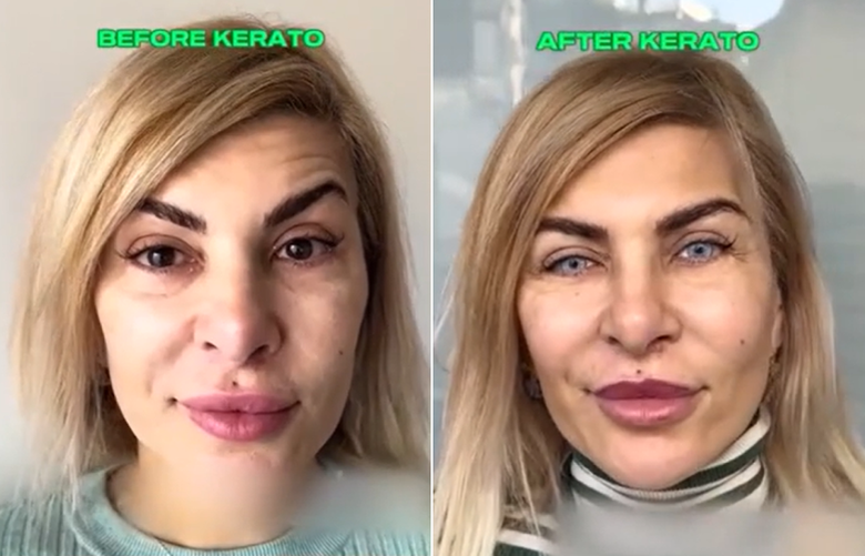 The new trend taking over and dividing users on TikTok is the eye tattoo – How Keratochromatosis Is Done